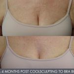 coolsculpting - before and 4 months after - bra bulge - front view