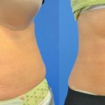 before and after coolsculpting - image 004 - front view
