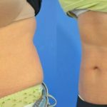 coolsculpting at academy face and body perth - before and after image 005 - 45 degree view