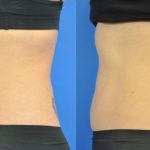fat freezing before and afters - image 006 - side view