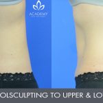 CoolSculpting - before and after image 09 - Academy Face & Body Perth