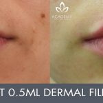 Dermal Fillers - Before and After 04 - Academy Face And Body - Perth