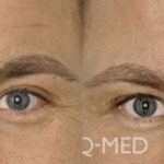 dermal fillers - before and after image 005 - Academy Face & Body Perth