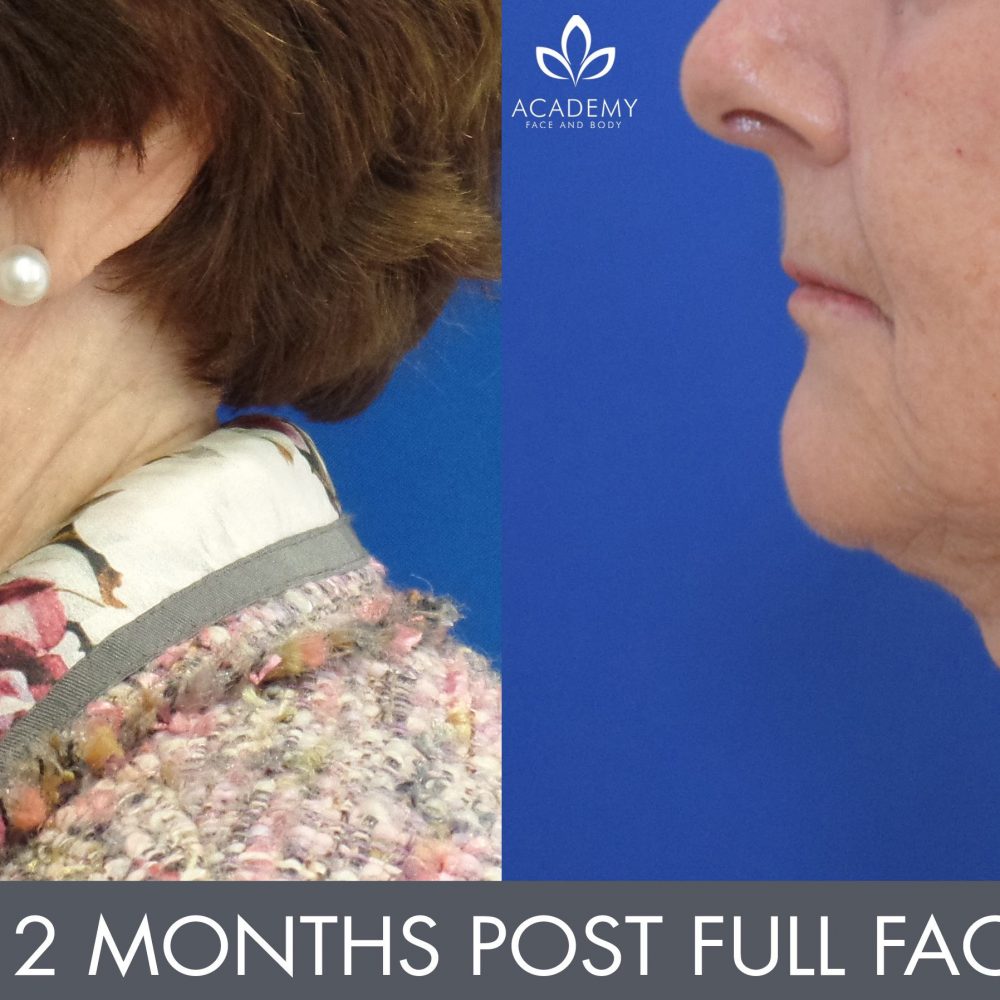 Facelift Perth MACS Lift Surgery Academy Face & Body
