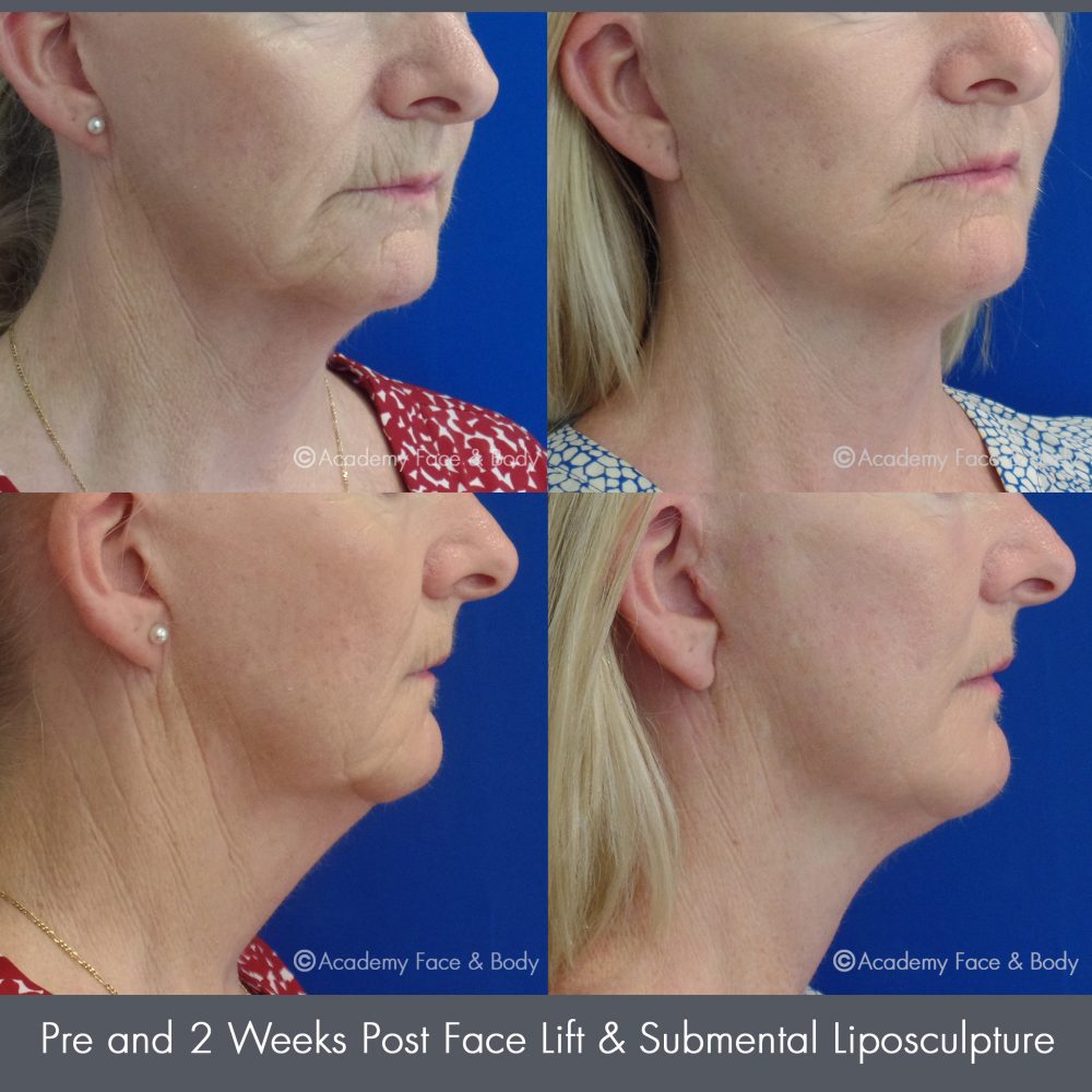 Facelift Perth MACS Lift Surgery Academy Face & Body
