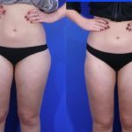 liposuction before and after image - Perth - Academy Face & Body