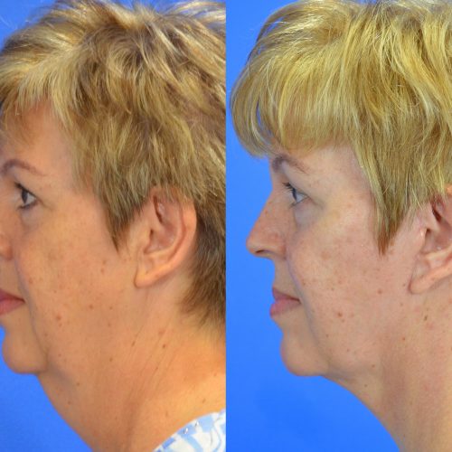 Facelift Before and After Gallery | Academy Face & Body