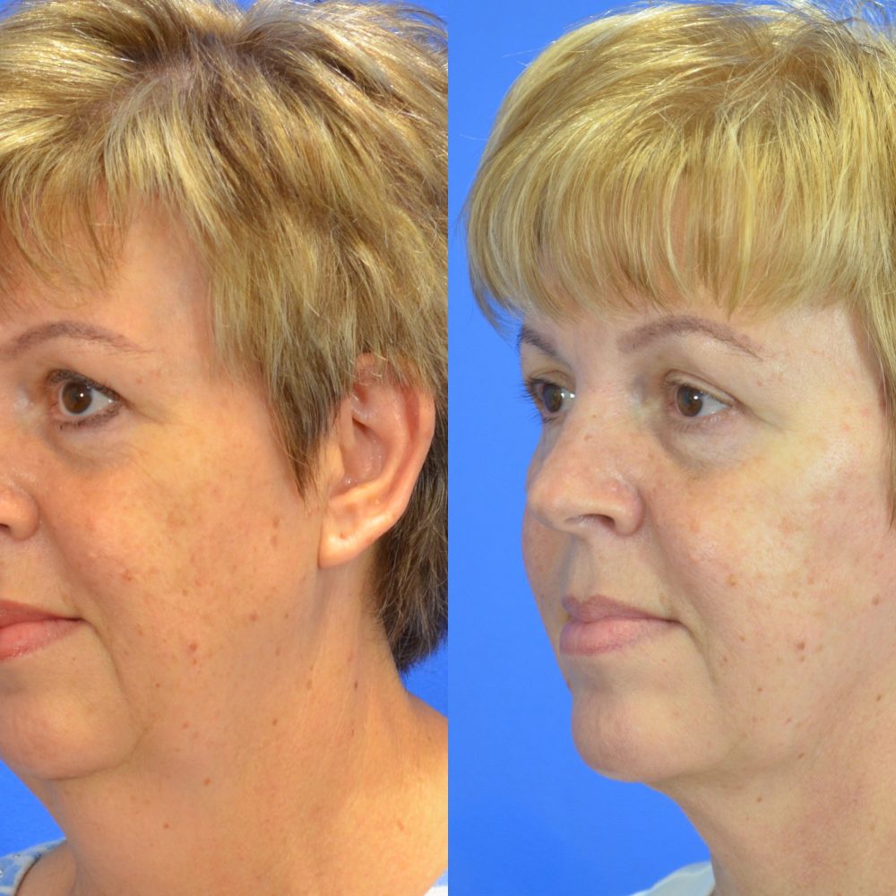 Facelift Before and After Gallery | Academy Face & Body