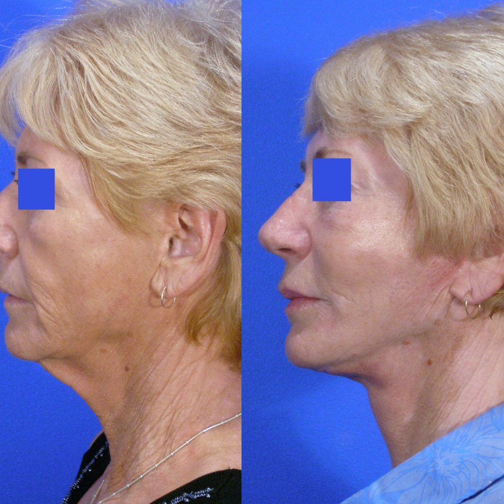 Facelift Before and After Gallery | Academy Face & Body