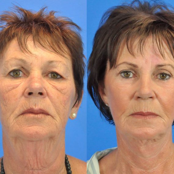 Facelift Before and After Gallery | Academy Face & Body