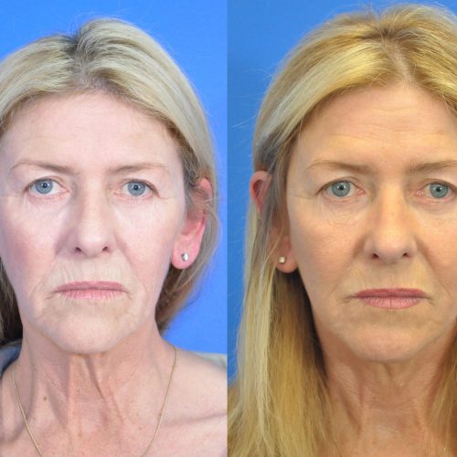 Facelift Before and After Gallery | Academy Face & Body