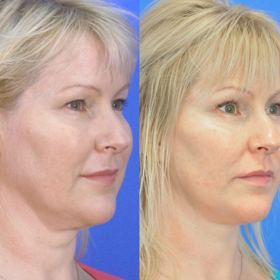 Facelift Before and After Gallery | Academy Face & Body