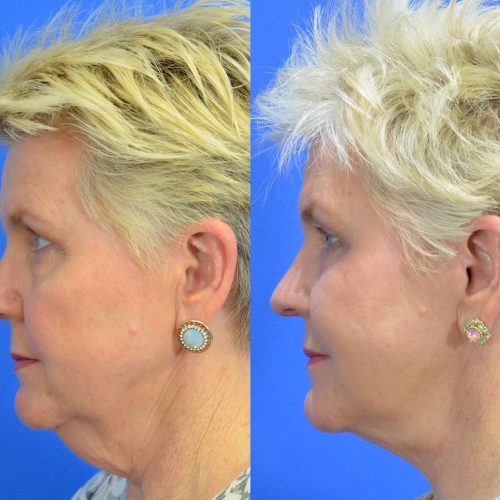 Facelift Before and After Gallery | Academy Face & Body