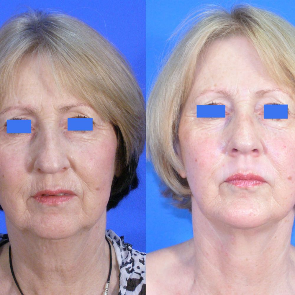 Facelift Before and After Gallery | Academy Face & Body