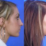 rhinoplasty - nose job - before and after image 20 - Academy Face & Body Perth