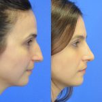 rhinoplasty - nose job - before and after image 05- Academy Face & Body Perth