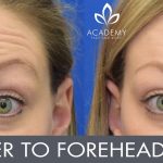 Anti-wrinkle injections (wrinkle relaxers) - before and after image 02 - Academy Face & Body Perth