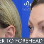 Anti-wrinkle injections (wrinkle relaxers) - before and after image 03 - Academy Face & Body Perth