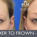 Anti-wrinkle injections (wrinkle relaxers) - before and after image 04 - Academy Face & Body Perth