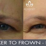 Anti-wrinkle injections (wrinkle relaxers) - before and after image 05 - Academy Face & Body Perth