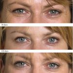 wrinkle injections - before and afters - Academy Face & Body Perth
