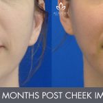 cheek implants - patient's before and after image 001 - Academy Face & Body Perth
