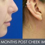 cheek implants - patient's before and after image 002 - Academy Face & Body Perth