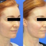 Fractional DOT Laser - before and after image 01 - Academy Face And Body