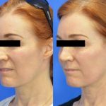 DOT Laser before and after - image 02 - Academy Face And Body