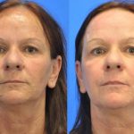 DOT Laser before and after - image 03 - Academy Face And Body