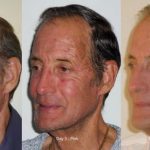 Fractional DOT Laser - before and after image 04 - Academy Face And Body