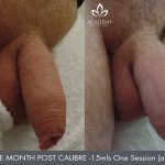 penis enlargement - before and after image 06 - Academy Face & Body Perth