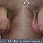 penis enlargement - before and after image 05 - Academy Face & Body Perth