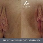 labiaplasty before and after - image 002
