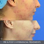 microdermabrasion - before and after image 01 - Academy Face & Body Perth