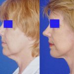 Mini Facelift (S-Lift) - before and after image 03 - Academy Face And Body Perth