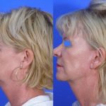 Mini Facelift (S-Lift) - before and after 44 - Academy Face And Body Perth