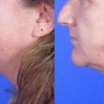 neck lift before and after image 001 - Academy Face & Body Perth