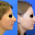 Nose Job (Rhinoplasty) - Before and After 01 - Academy Face And Body