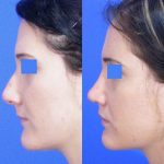 Nose Job (Rhinoplasty) - Before and After 02 - Academy Face And Body