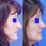 Nose Job - Rhinoplasty - Before and After 04 - Academy Face And Body