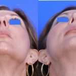 Nose Job - Rhinoplasty - Before and After 05 - Academy Face And Body