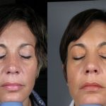 PRP skin rejuvenation - before and after image 02 - Academy Face & Body Perth