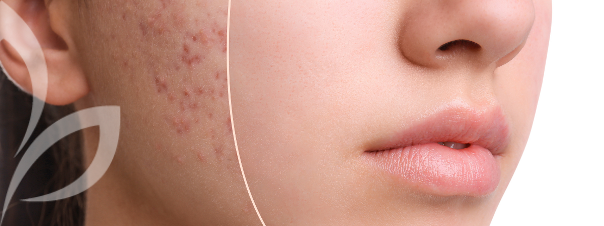 best acne treatments perth