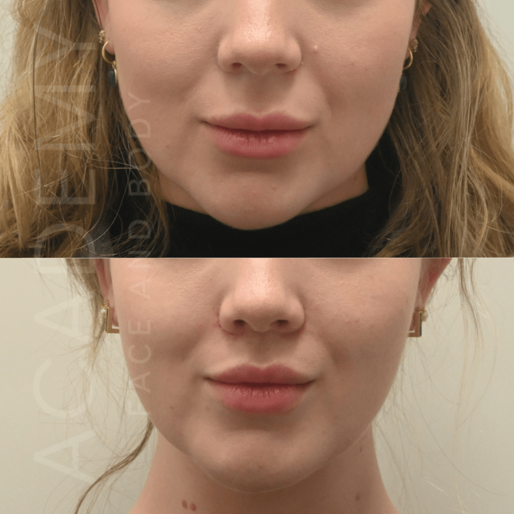 academy-face-and-body-LIP-1