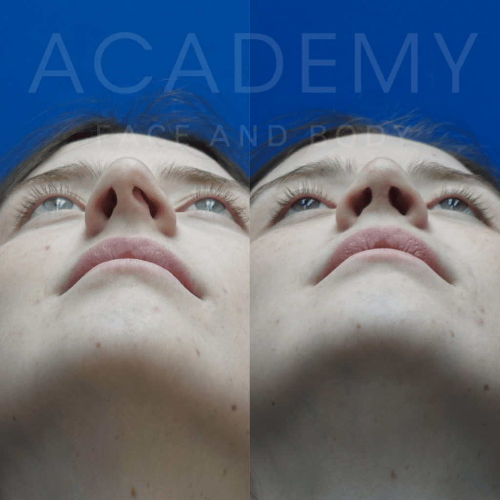 academy-face-and-body-NOSE-1