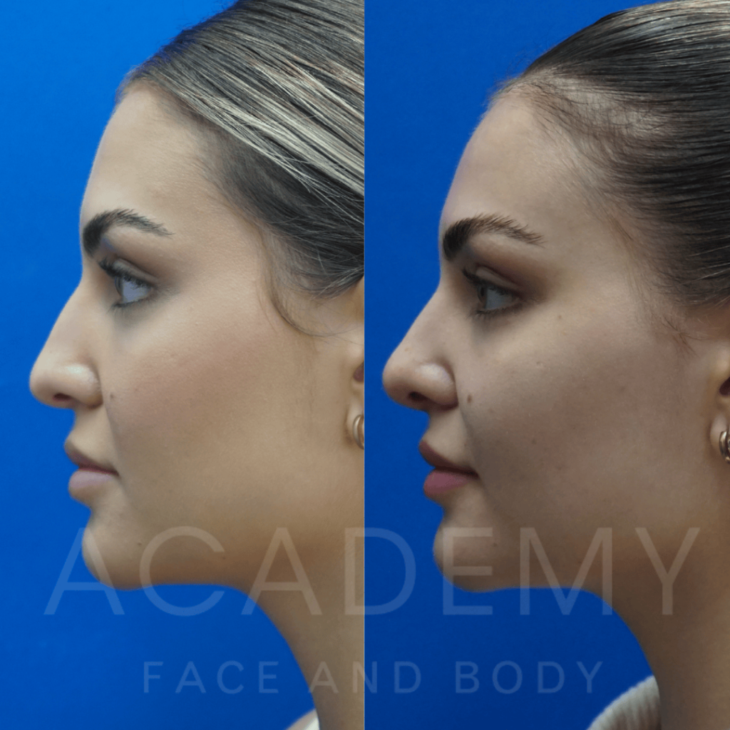 academy-face-and-body-NOSE-11