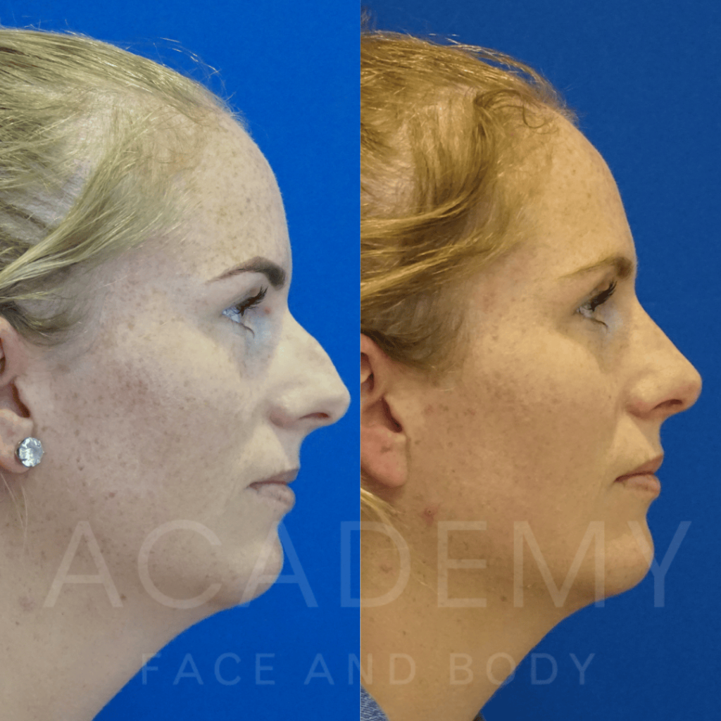 academy-face-and-body-NOSE-13