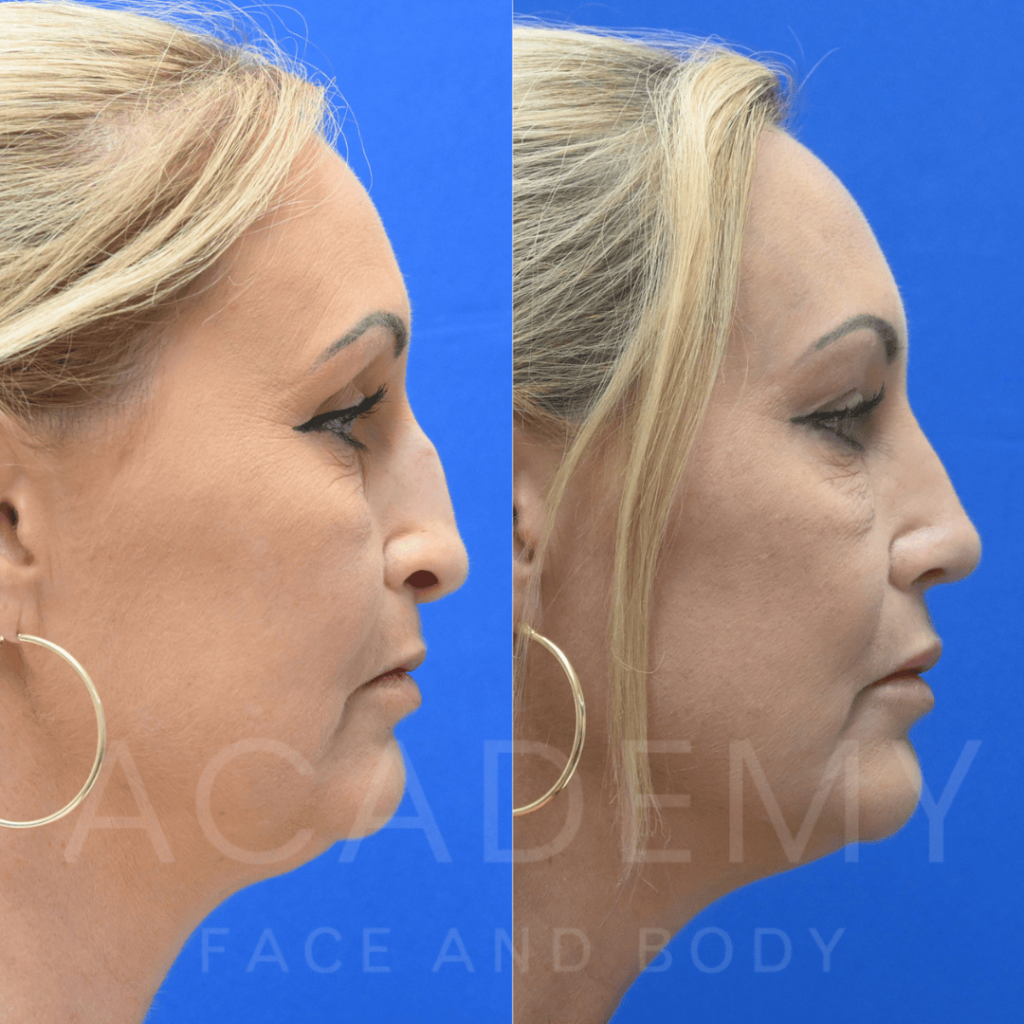 academy-face-and-body-NOSE-15