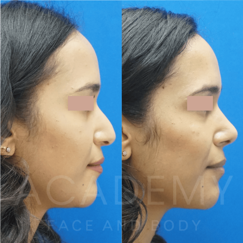 academy-face-and-body-NOSE-16